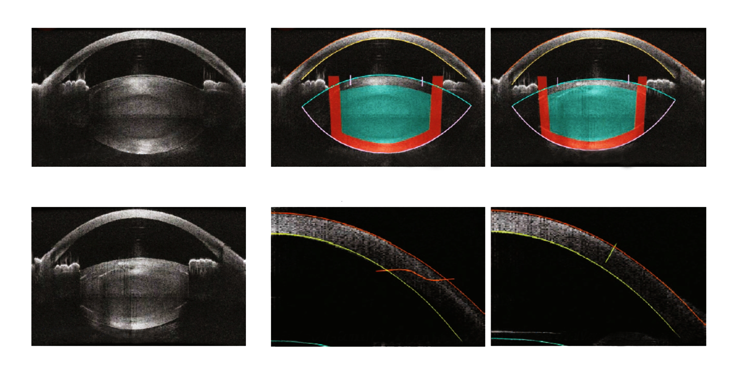 tomographie